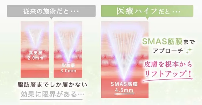 TCB東京中央美容外科のたるみ・リフトアップコースのおすすめなポイント1